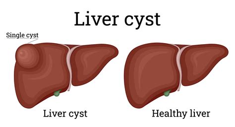 What Cause Cyst On Your Liver